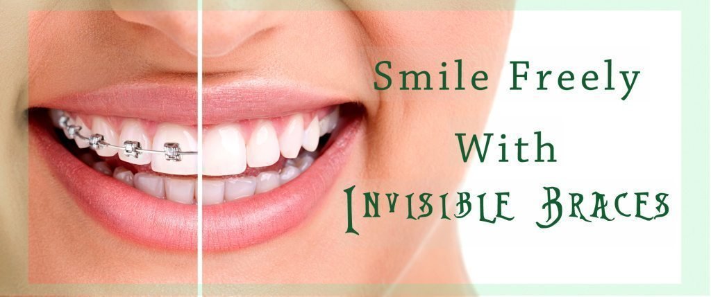 smile freely with invisible Braces- indorehd.psd