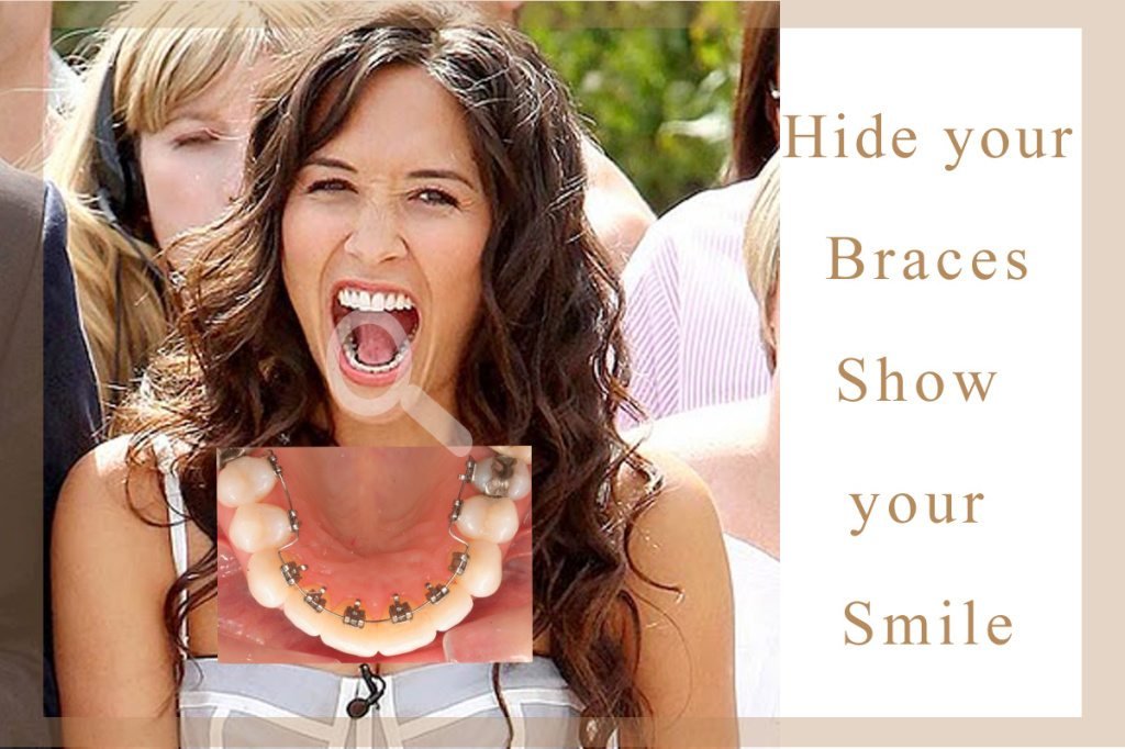  smile-freely-with-invisible-braces1-indorehd